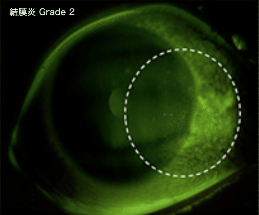 結膜炎 Grade 2