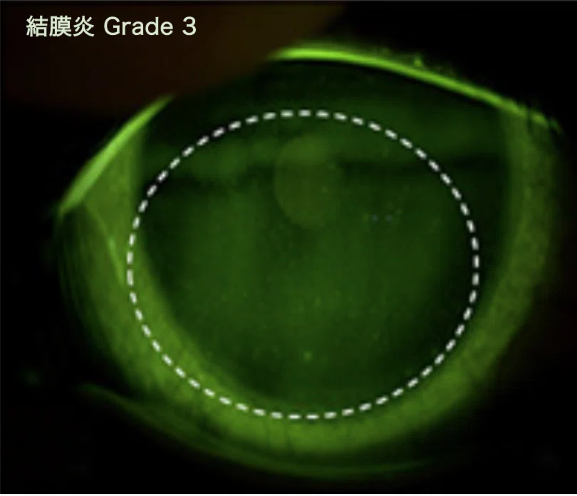 結膜炎 Grade 3