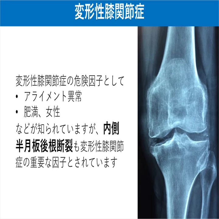 内側半月板後根断裂とは Y K Note