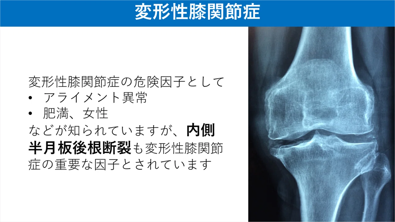 内側半月板後根断裂とは Y K Note 内側半月板後根断裂とは Y K Note