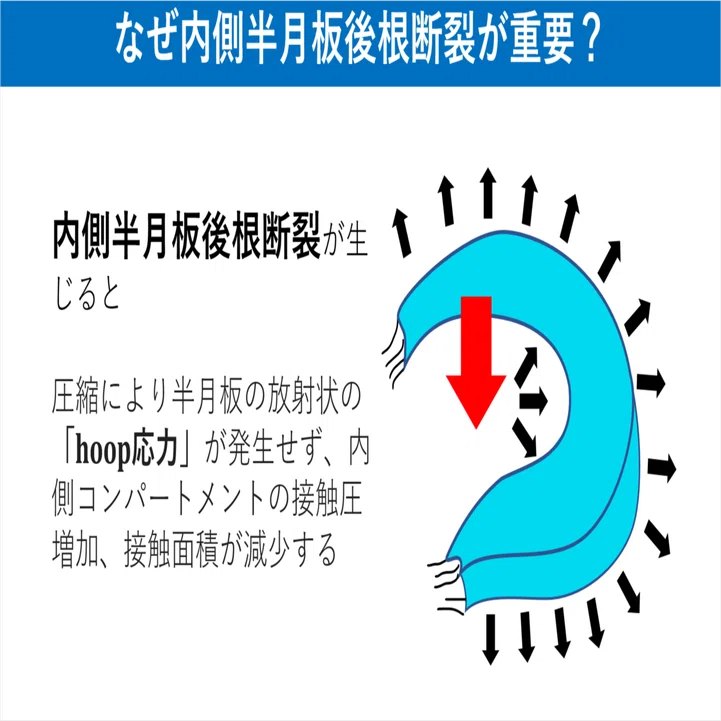 内側半月板後根断裂とは Y K Note