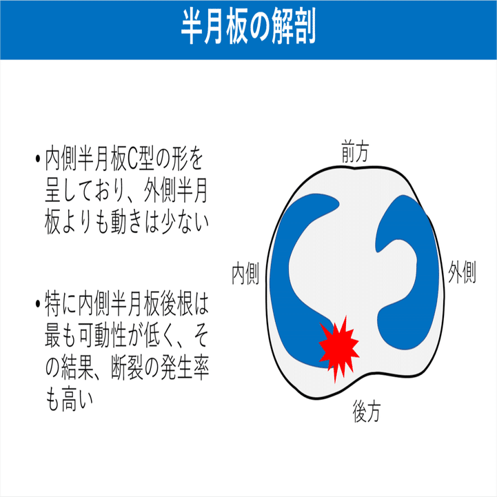 Medial Meniscus Extrusion Mmeとは Y K Note