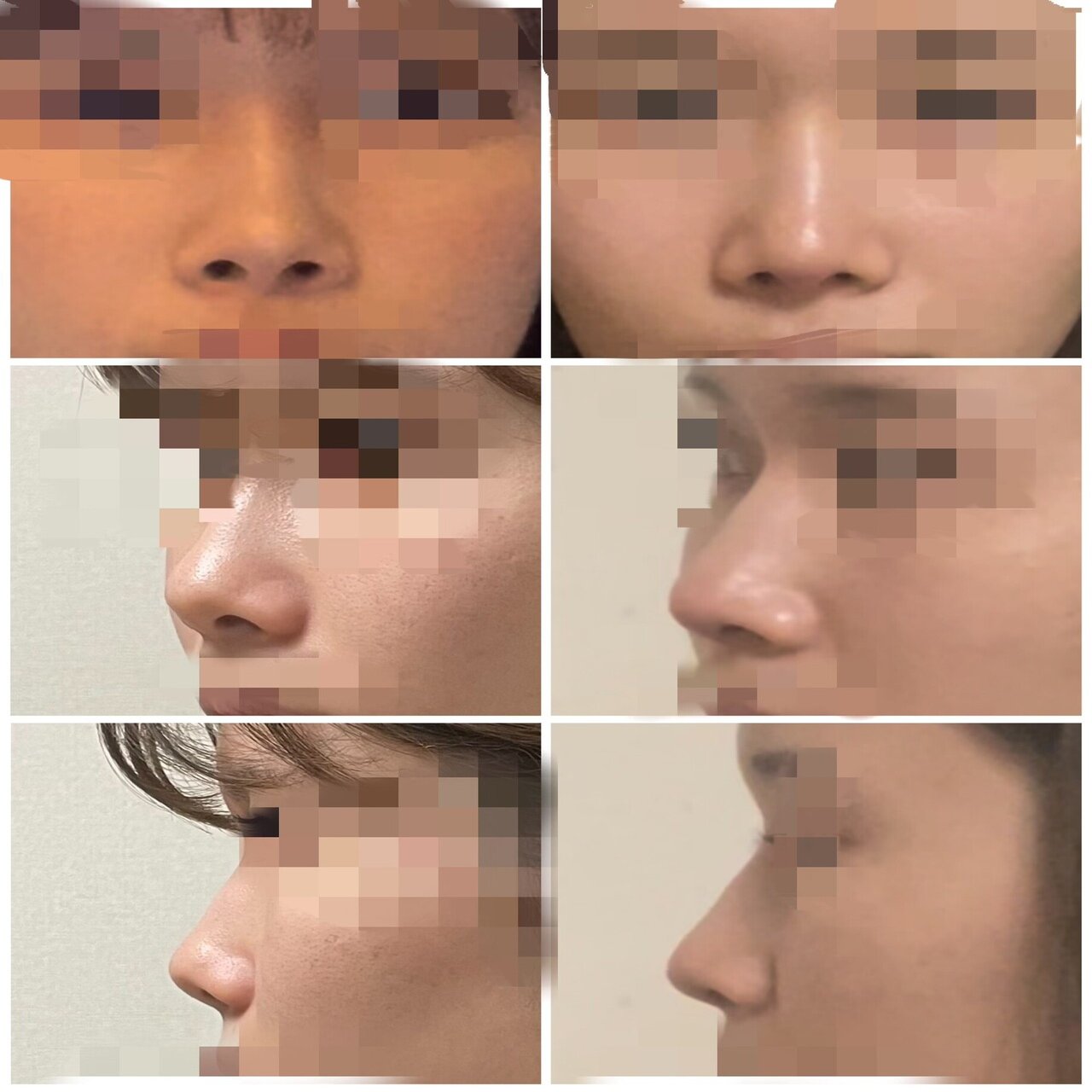 鼻整形】鼻尖形成＋耳介軟骨移植🇯🇵｜yui🤍, image size:1280x1706