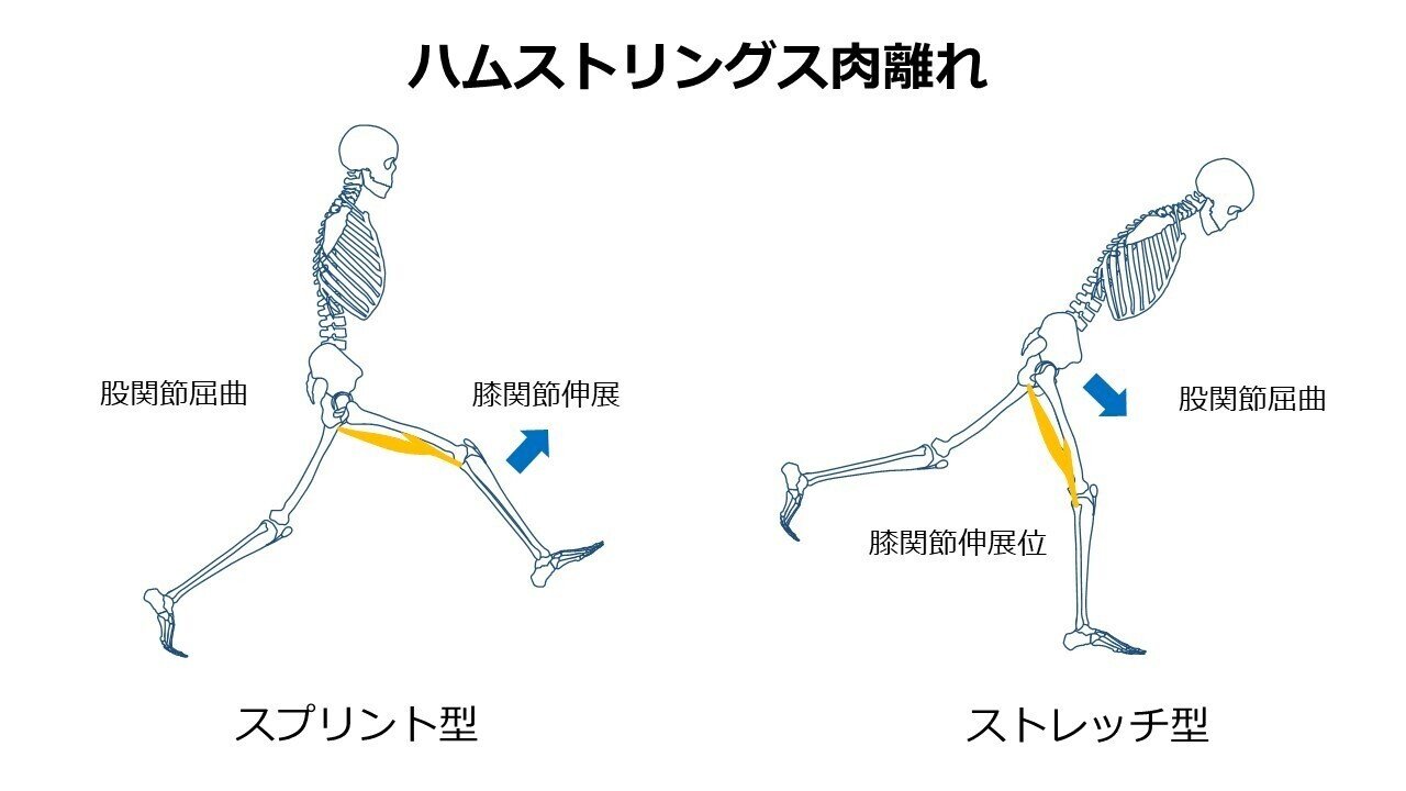 スポーツ復帰に向けたハムストリングス肉離れに対するアプローチ L Fit Note スポーツ復帰に向けたハムストリングス肉離れに対するアプローチ L Fit Note