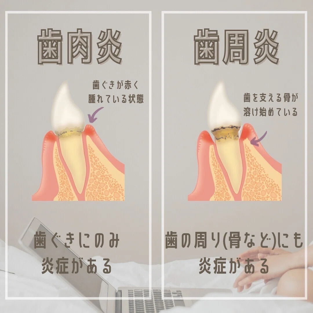 歯肉炎と歯周炎の違い!簡単に解説! 歯肉炎→歯ぐきにのみ炎症 歯周炎→歯ぐき以外の歯周組織にも炎症|dental studio|note