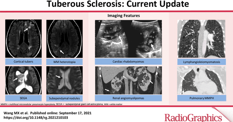 結節性硬化症の診断