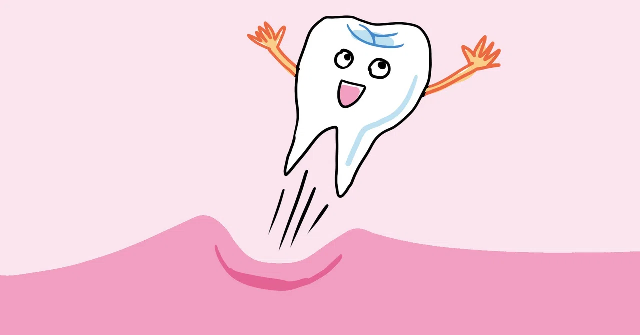 The story of having all four wisdom teeth removed at once in Germany 1｜ノラ