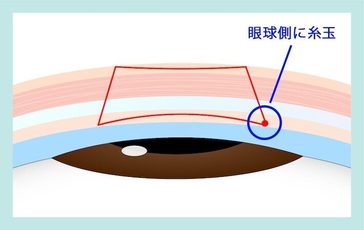 眼球側に糸玉