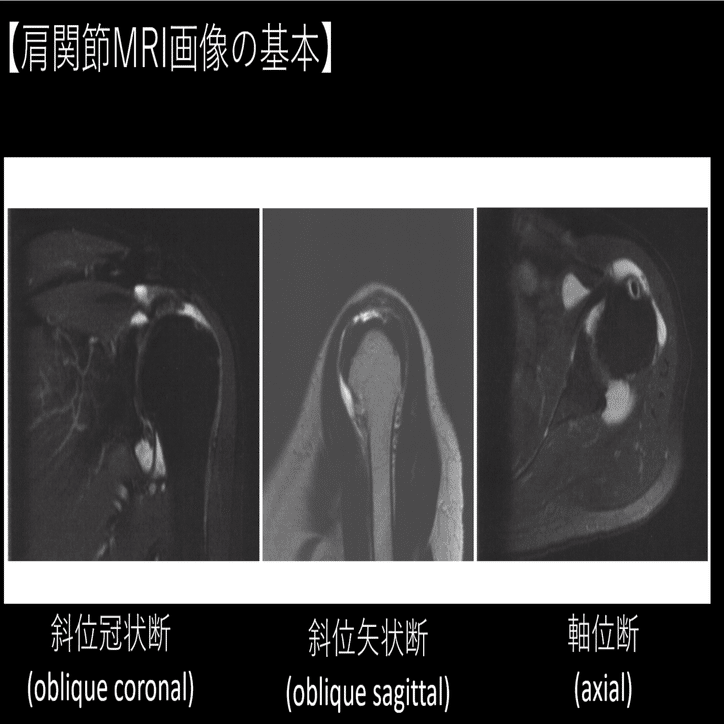 肩関節のMRI = MRI GH joint : 読影ポイントと新しい知見 肩関節のMRI = MRI GH joint : 読影ポイントと新しい知見 肩関節のMRI
