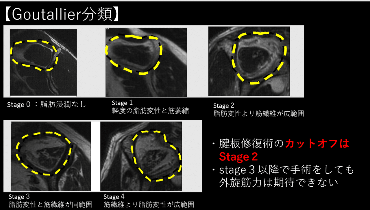 画像診断 13年2月号 33ー2 特集 肩関節疾患の画像診断 MRI+α-