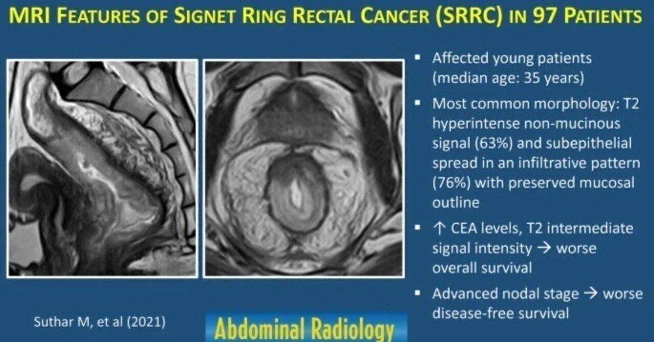 Signet Ring Rectal Cancer(SRRC)｜TKG画像診断｜note