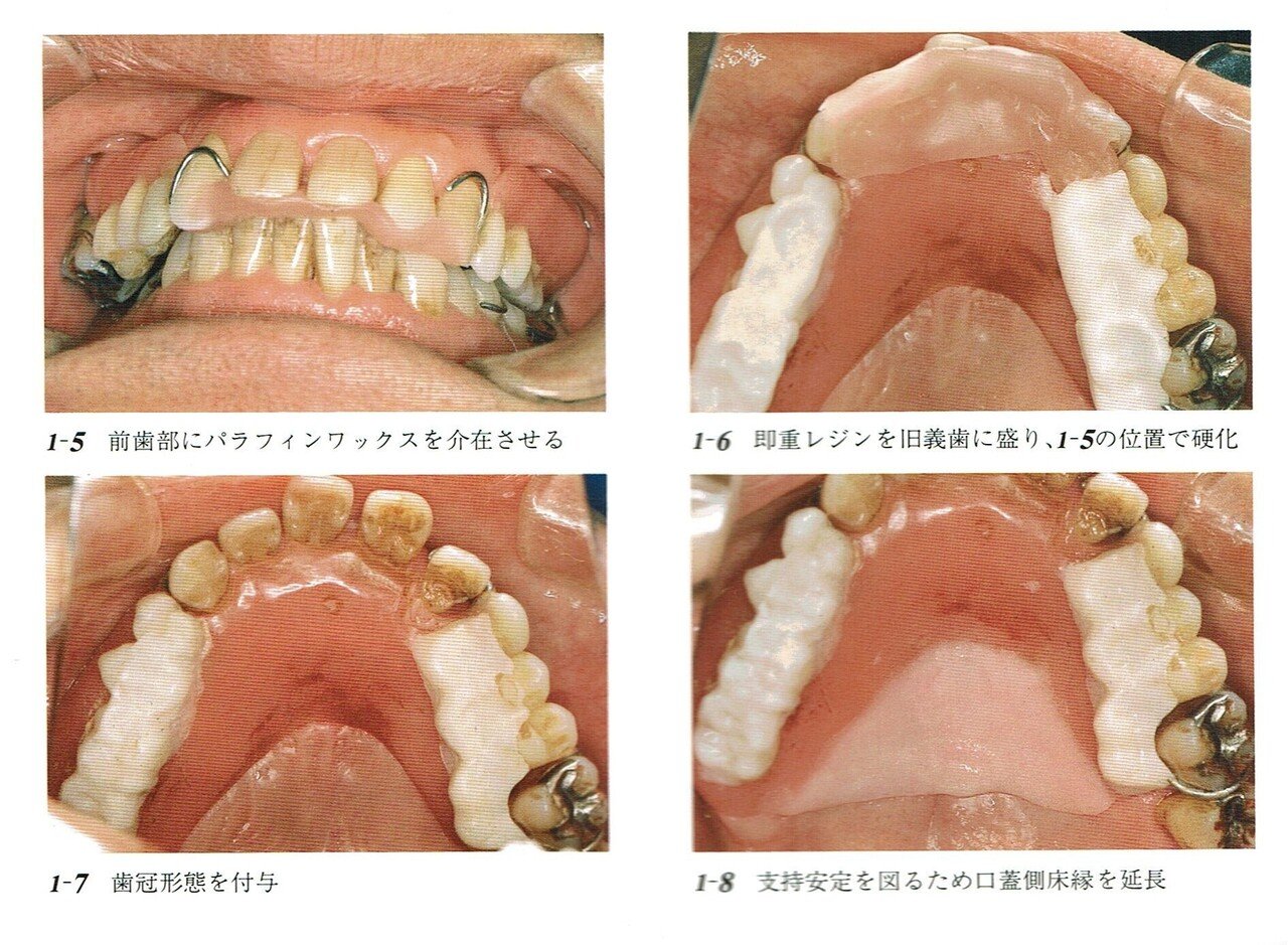 アナトミカル日歯咬合面形成法 アナトミカル日歯咬合面形成法
