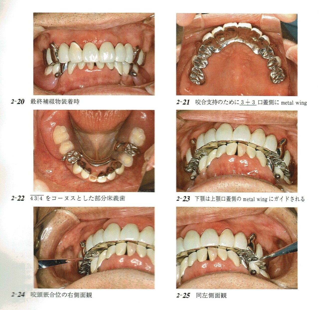 咬合再構成における治療用義歯(装置)の意義について|東邦歯科 咬合再構成における治療用義歯(装置)の意義について|東邦歯科