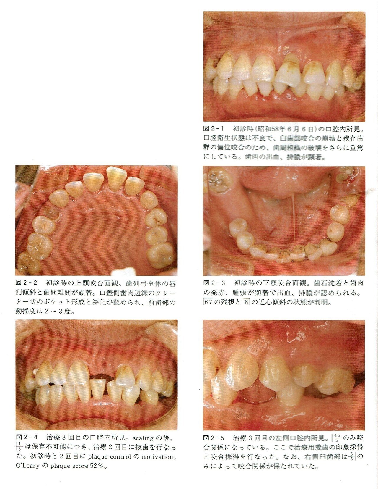 日本の歯科保険診療報酬体系内では咬合診断は認められず｜東邦歯科診療所
