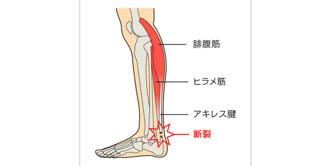 アキレス腱を断裂し 手術しました その１ 堀口 光也 A Self Styled Philosopher Note