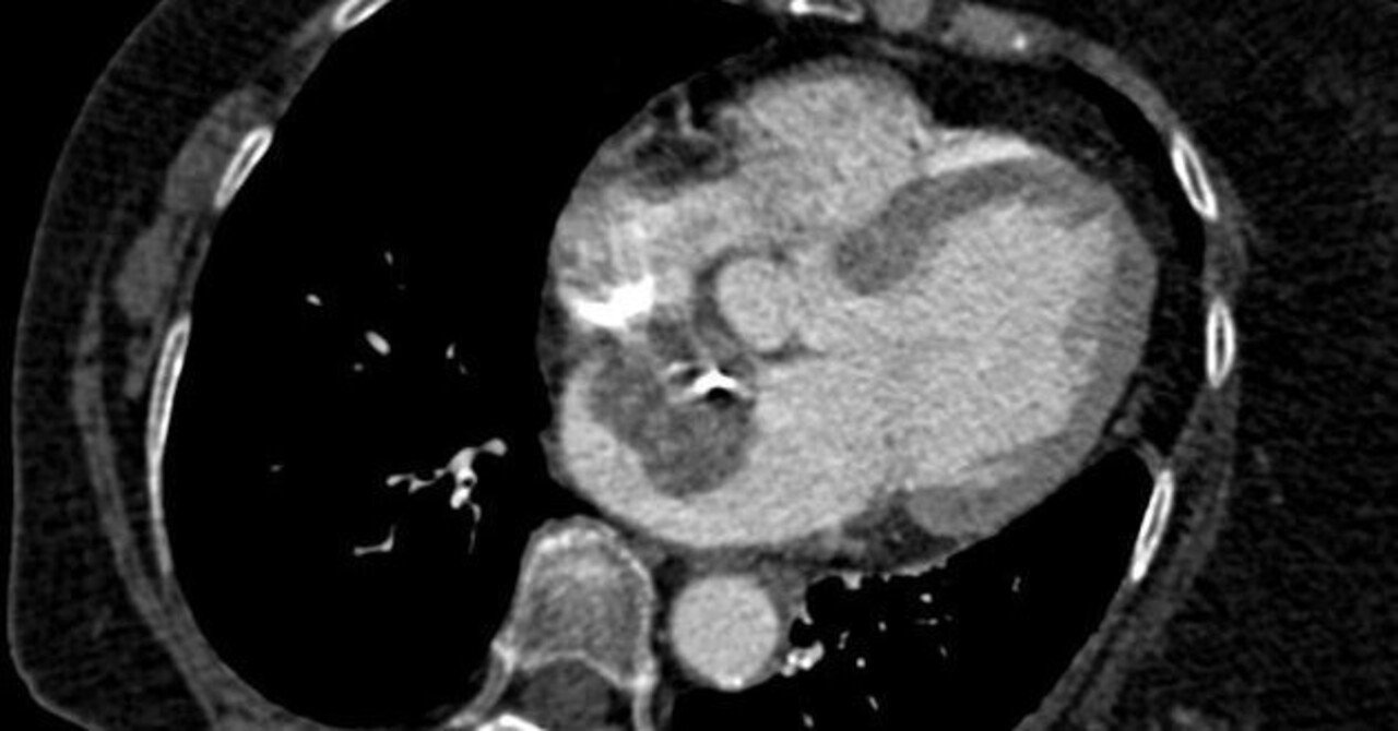 腫瘍随伴症候群の患者の今後の見通しはどのようなものですか?