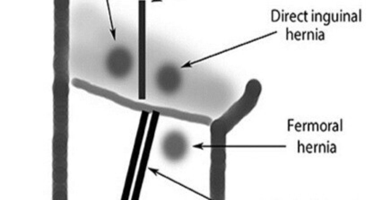 大腿ヘルニア後の見通し