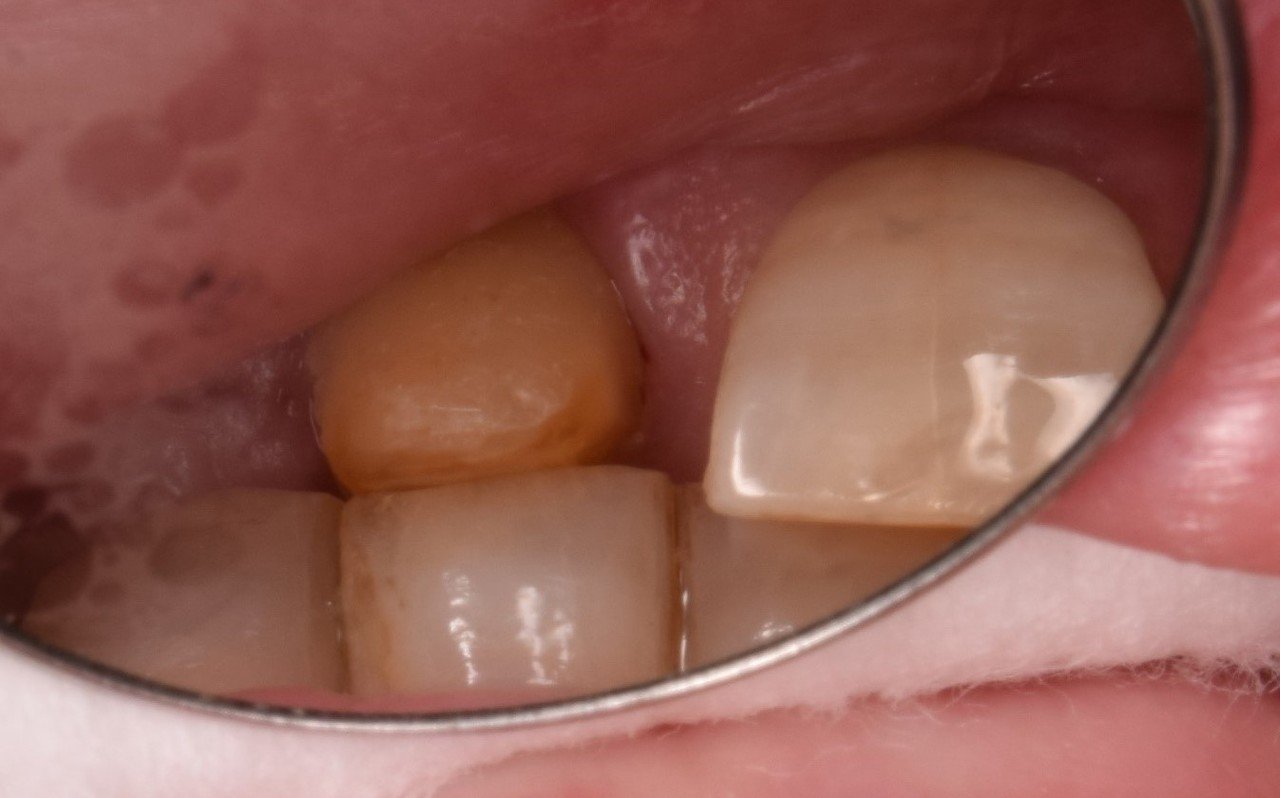 歯は急速に移動することを再認識した症例|かずぴん