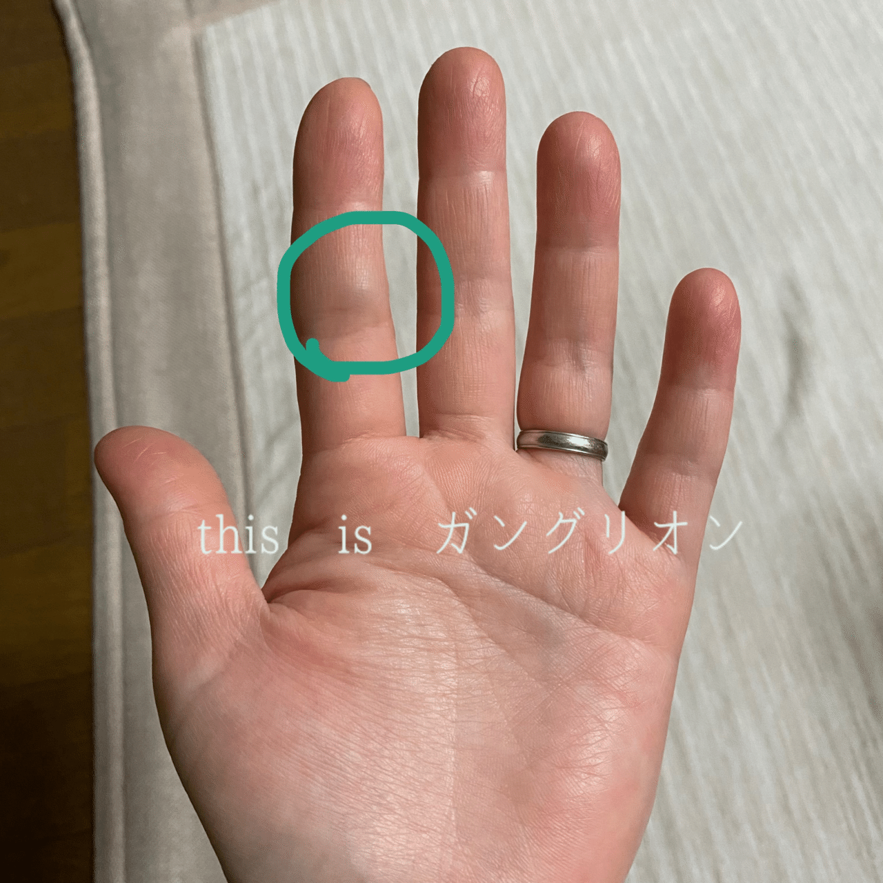 はたして 私はガングリオンと共存できるのか みるみる Note