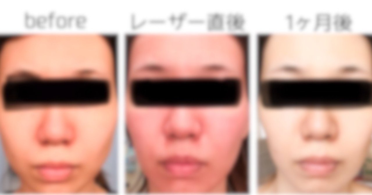 コスパ良し フラクショナルco2レーザーから１ヶ月後 ダウンタイムあり ウニ Wooni Note