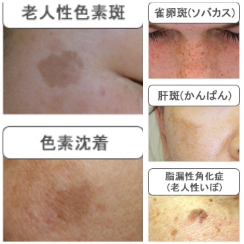 Pフエィシャル失敗 Tot シミ取りのはずがシミが濃くなった Tot レーザーで気をつける事とは ぐいちゃん Note Pフエィシャル失敗 Tot シミ取りのはずがシミが濃くなった Tot レーザーで気をつける事とは ぐいちゃん Note