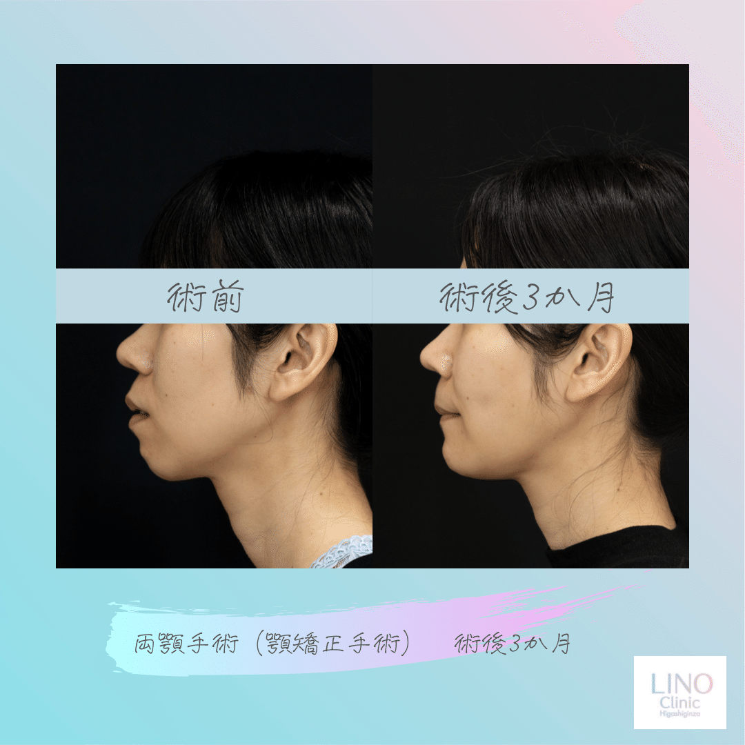 ゴボ口治療術後3か月〜両顎手術〜【骨切り・顎矯正手術】｜Behind the