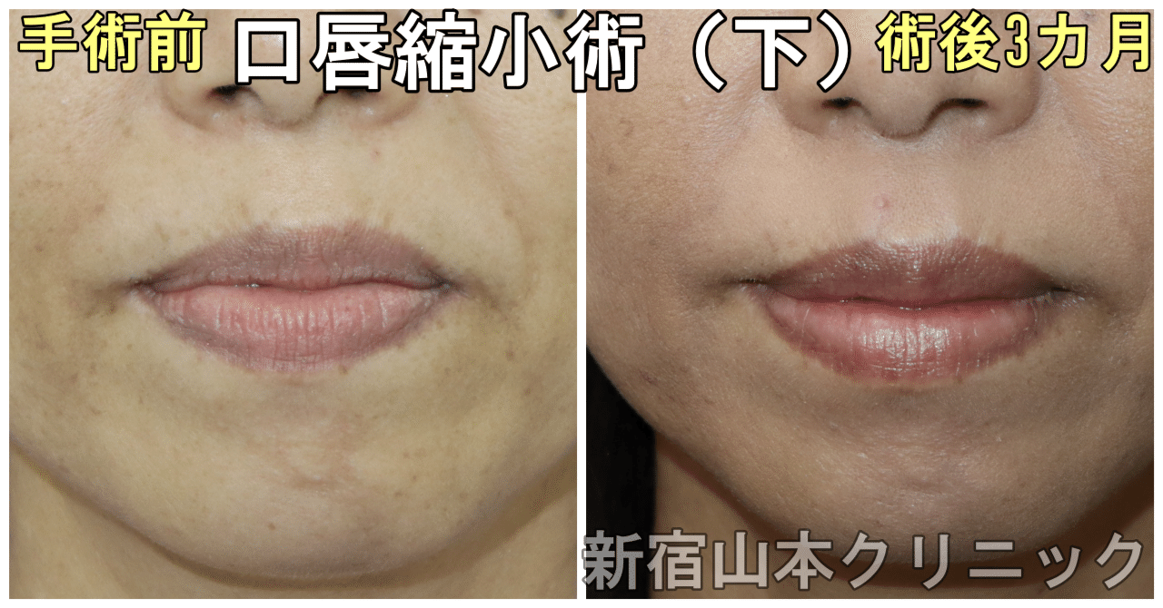 口唇縮小術 唇薄くする手術 の傷って綺麗に治るの 新宿 山本クリニック Note