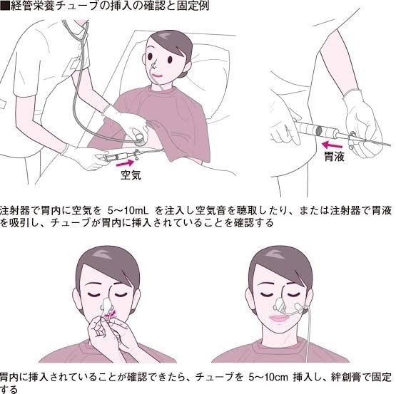 Ngチューブと副鼻腔炎 森永 康平 ミルキク Note Ngチューブと副鼻腔炎 森永 康平 ミルキク Note