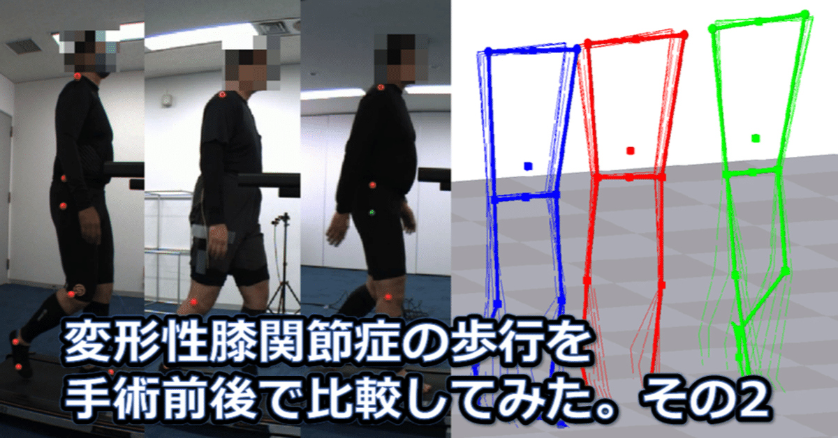 変形性膝関節症の歩行を手術前後で比較してみた。 その2