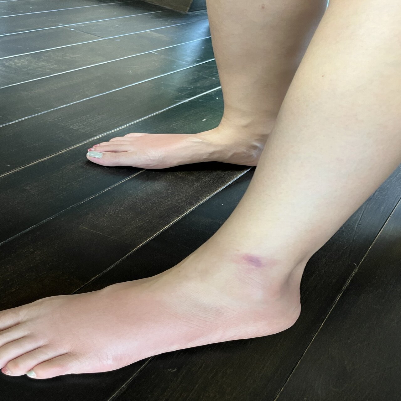 注意 妻がブヨに噛まれて とんでもないことに 皆様も本当にお気をつけてください の法則 Sukesan Note