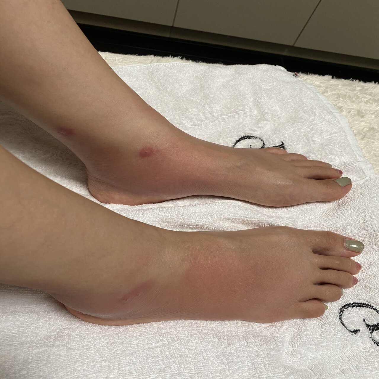 注意 妻がブヨに噛まれて とんでもないことに 皆様も本当にお気をつけてください の法則 Sukesan Note