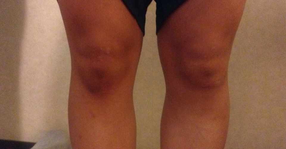 現場で気づいた膝の怪我の原因 Ryosuke Akayama 赤山僚輔 Note