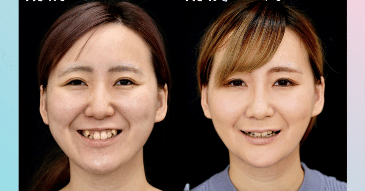 両顎手術のメリット