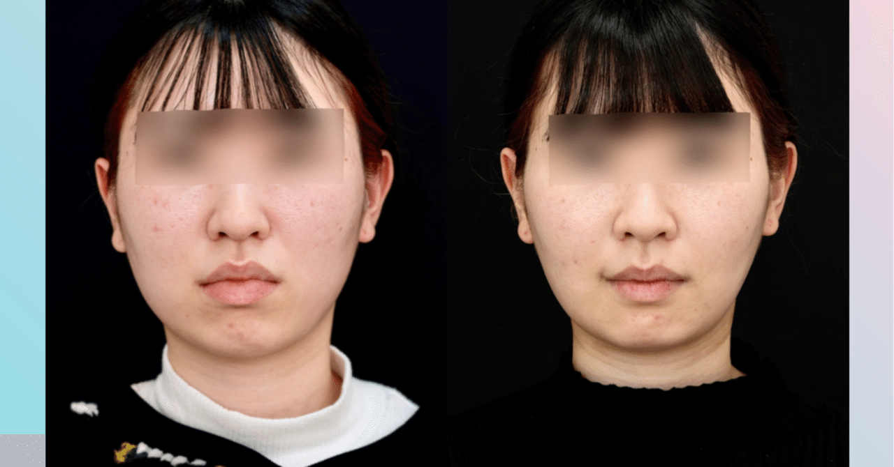 ゴボ口を治療する骨切り〜両顎手術〜術後3か月【輪郭整形・顎矯正手術】