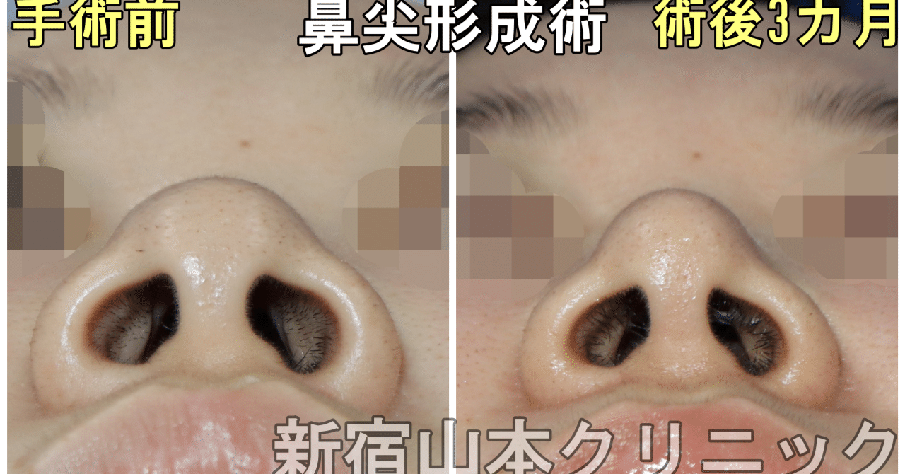 鼻尖形成術 団子鼻手術 後につらい事 新宿 山本クリニック Note