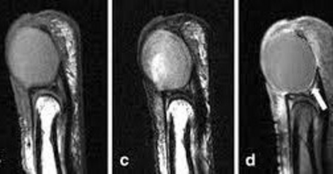 爪下類表皮嚢胞|TKG画像診断|note