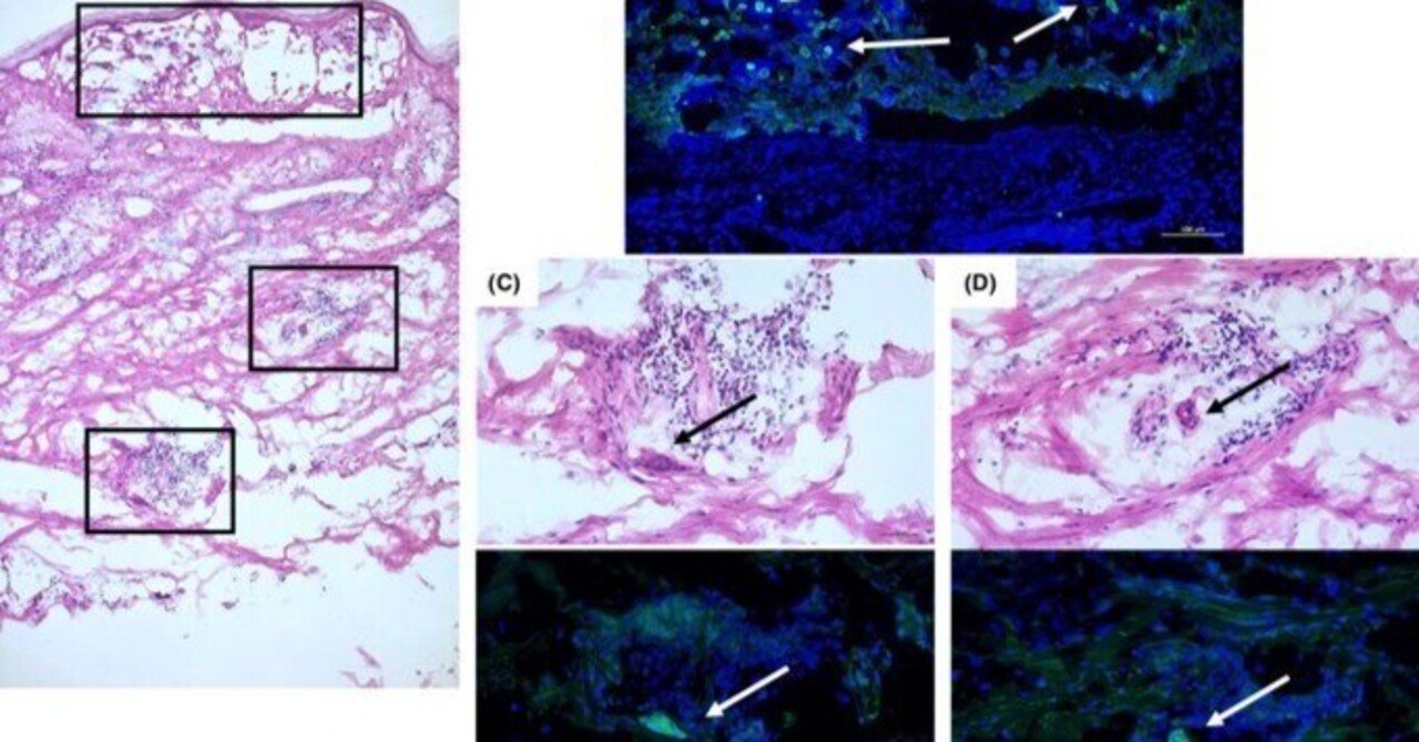 診断における「ハッチンソン病」の他の意味