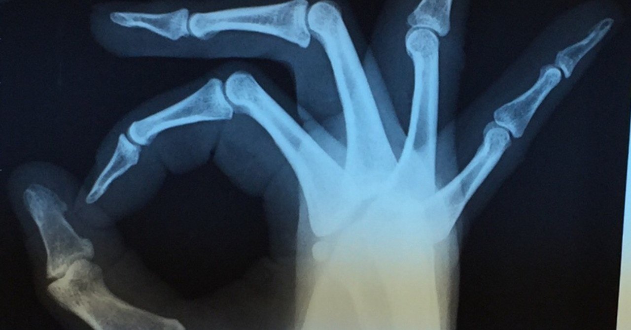 腰痛 背中 脇腹 Toru Furukawa Note