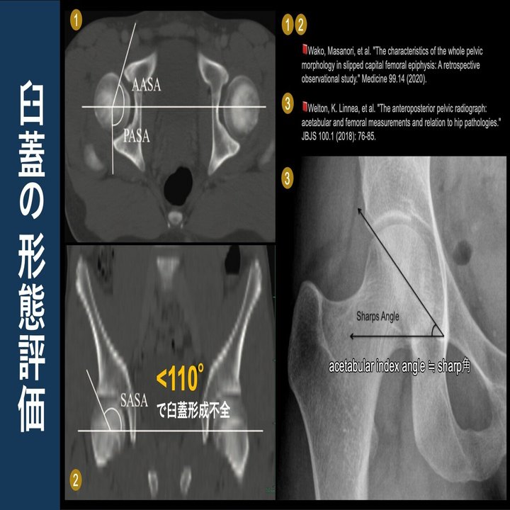 ドナルド脱臼 脱臼指導は必要？臼蓋の形態的変化の視点｜Super Human | 理学