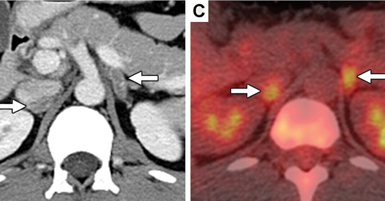 自己免疫性副腎炎とは何ですか?