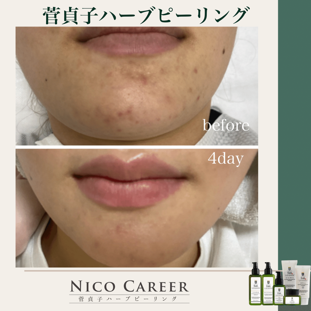 ハーブピーリング 3回分【わかりやすい説明書付き】 ハーブピーリング3回分わかりやすい説明書付き 元エステ直伝】ハーブ