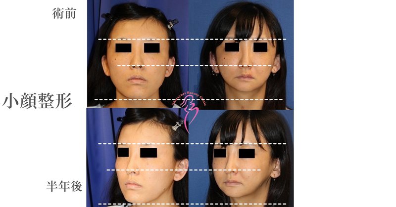 小顔整形 の新着タグ記事一覧 Note つくる つながる とどける