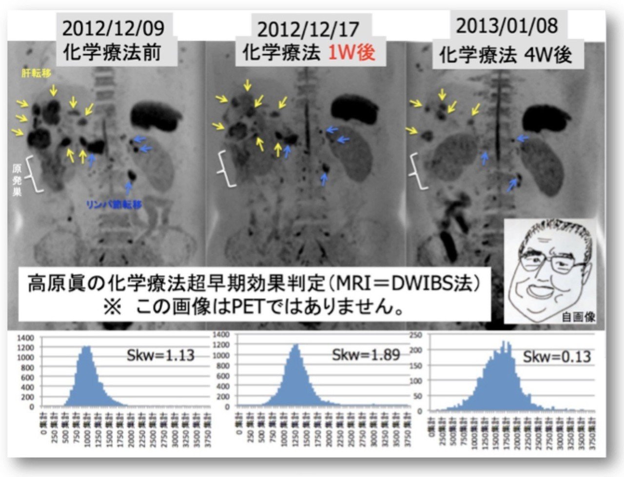 平成の終わりに、痛くない乳がん検診を始めて｜たろりん（高原太郎）