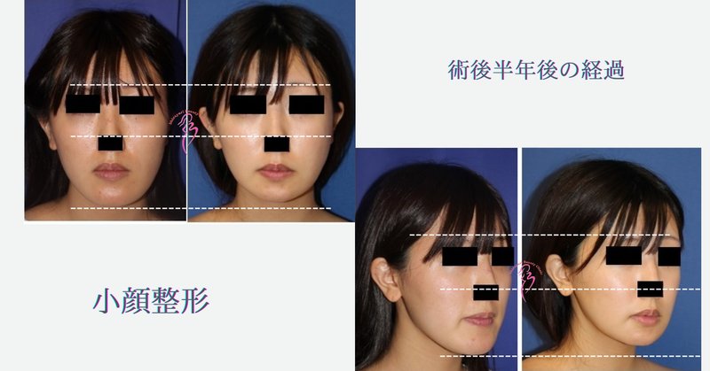 小顔整形 の新着タグ記事一覧 Note つくる つながる とどける