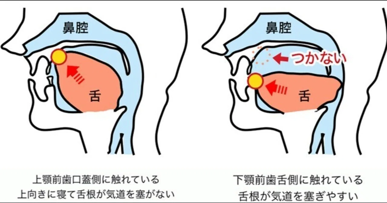天然歯調整による縫合のズレとアンテリアガイダンス。下あごが上がる 