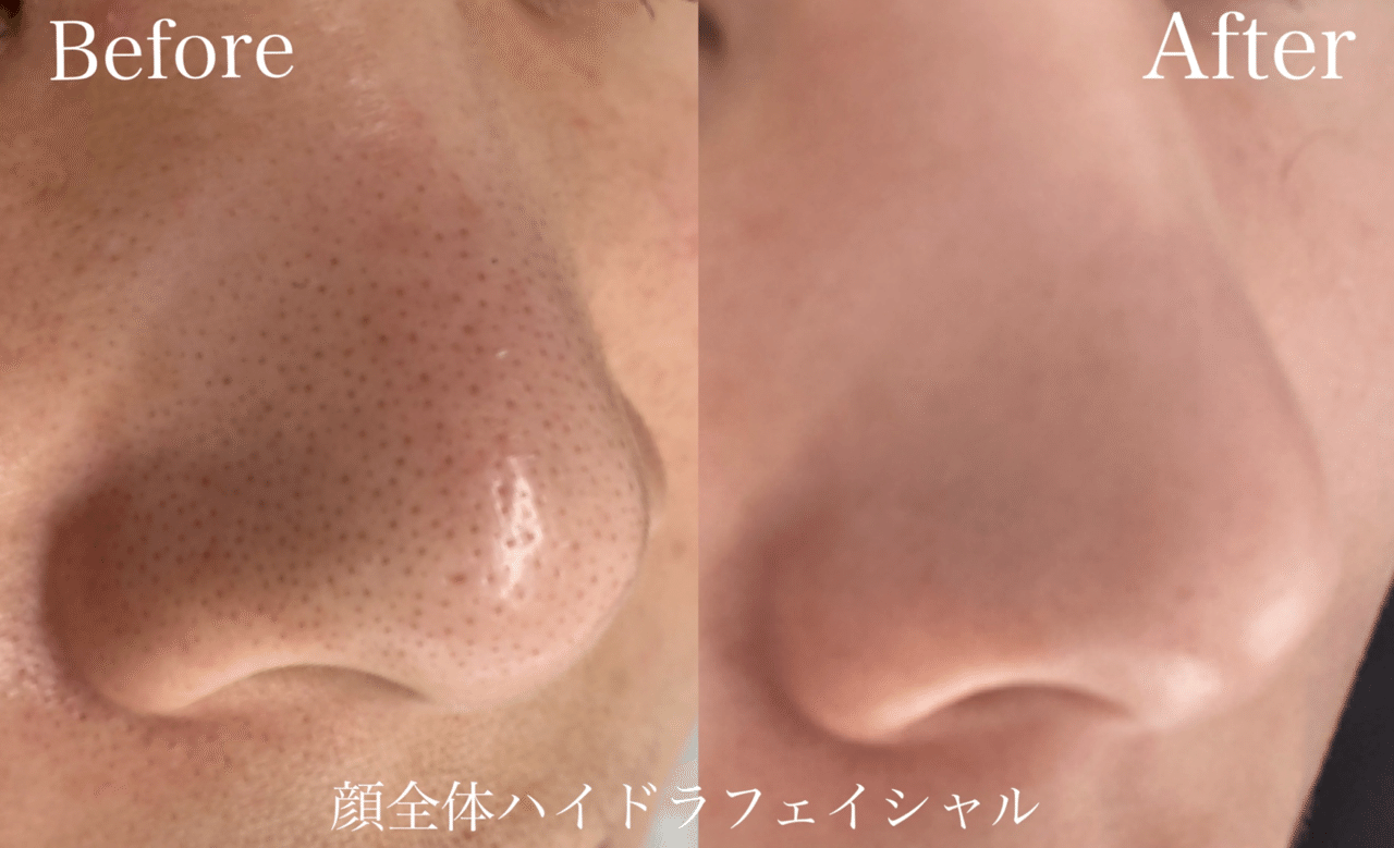 毛穴ハイドラフェイシャル｜講師/セラピスト Maiko