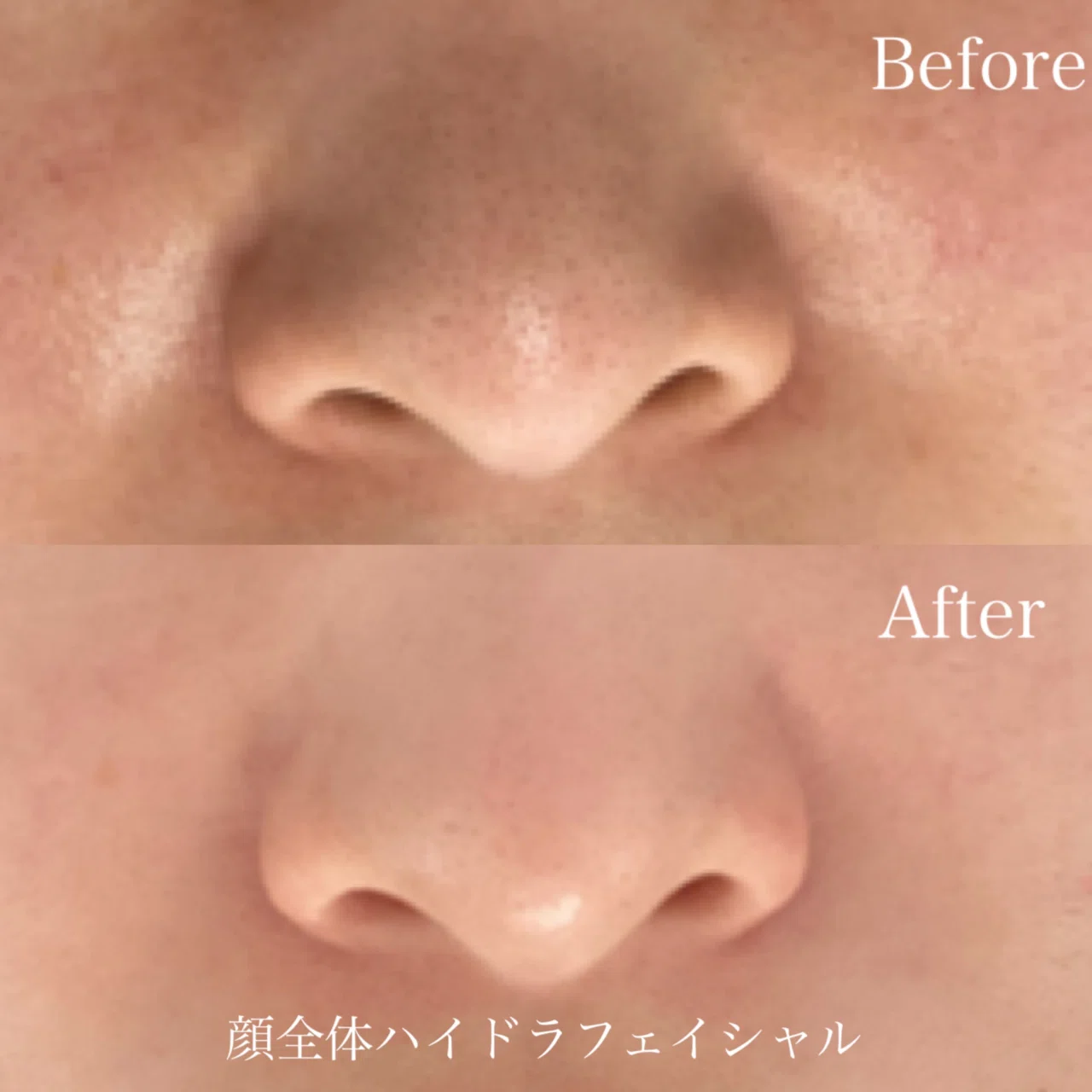毛穴ハイドラフェイシャル|_career_beauty