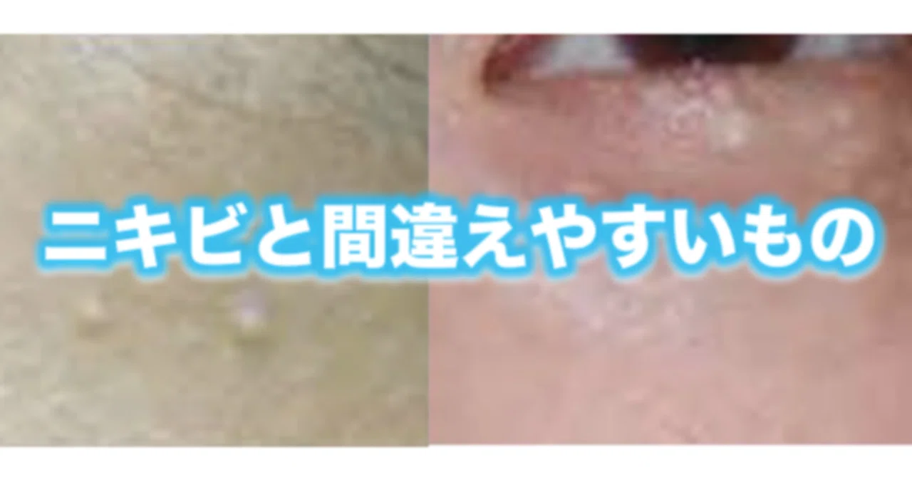 稗粒腫(はいりゅうしゅ)と汗管腫(かんかんしゅ)|片柳ちひろ/ニキビ博士