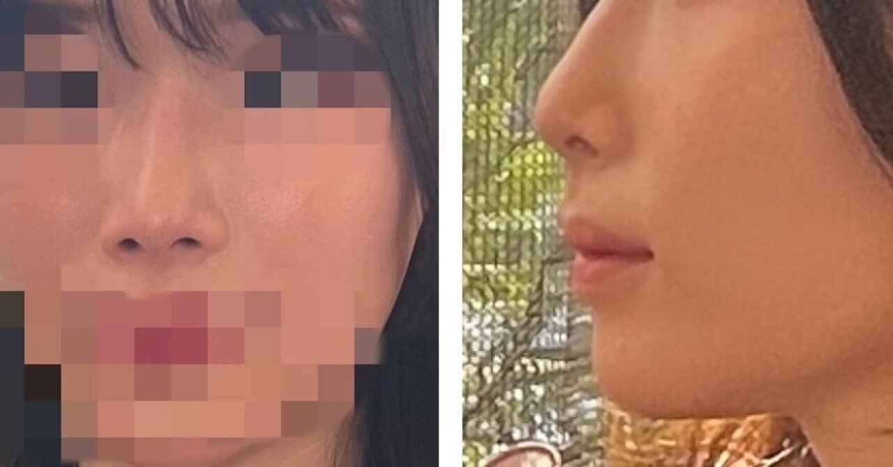 鼻整形】鼻尖形成＋耳介軟骨移植🇯🇵｜yui🤍, image size:1280x670