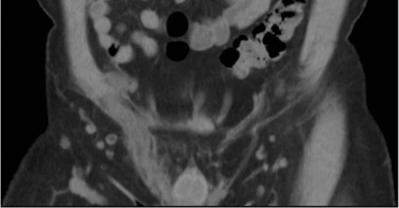 Vasitis(精管炎)鼠径ヘルニアのmimicker｜TKG画像診断